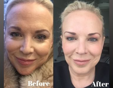 'I had too much botox - here's the treatment that fixed it' FEATURED