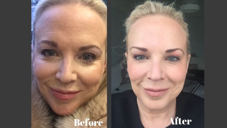 'I had too much botox - here's the treatment that fixed it' MAIN