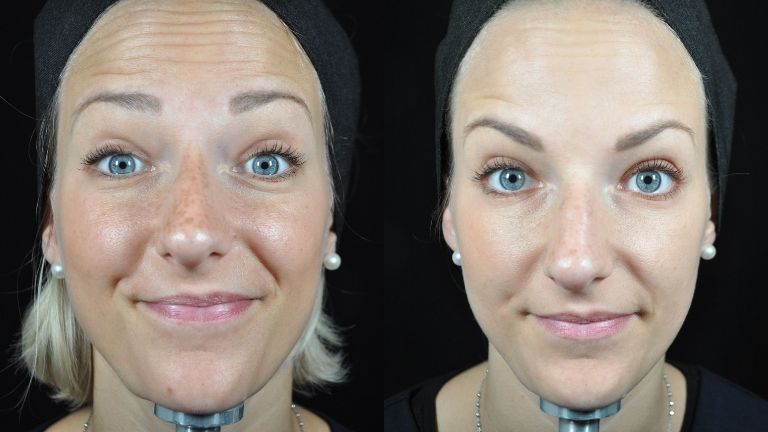 Botox for the First Time? Here's What to Expect