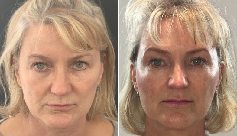 The non-surgical face lift that instantly transformed this woman’s face