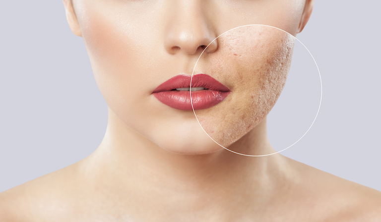 skin with acne healthista 