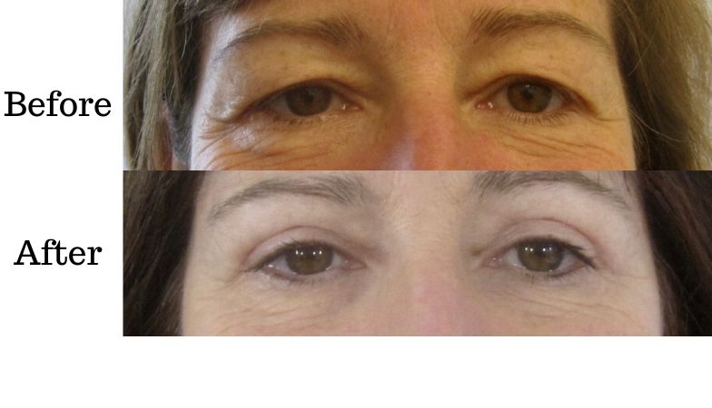 The 30-minute eye lift that transformed this woman’s face