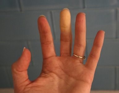 Raynaud's FEATURED (1)