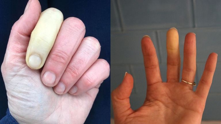 Raynaud's Syndrome