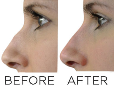 before-and-after-nose-filler,-nose-fillers-by-healthista.com