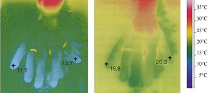 hands before-Raynaud's Syndrome