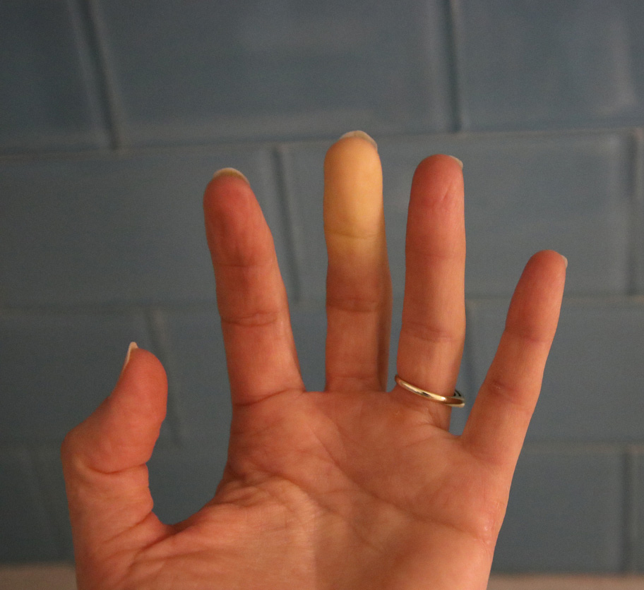 raynauds-pic.jpg-Raynaud's Syndrome