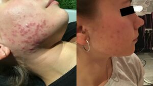 Young LDN - 'the skincare clinic that helped to clear my acne'