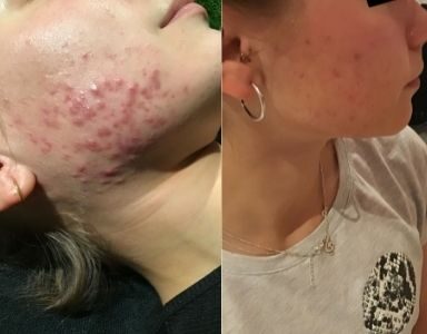 Young LDN - 'the skincare clinic that helped to clear my acne' FEATURED