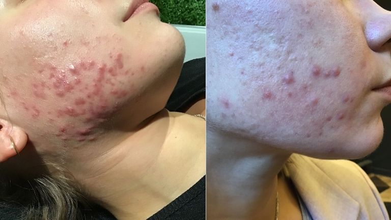 Young LDN - 'the skincare clinic that helped to clear my acne' MAIN