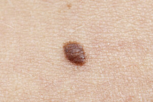 The-warning-signs-of-cancerous-moles-and-what-to-do-about-them-mole.jpg