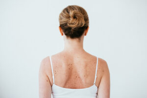 back view of woman with melanoma on diseased skin isolated on white