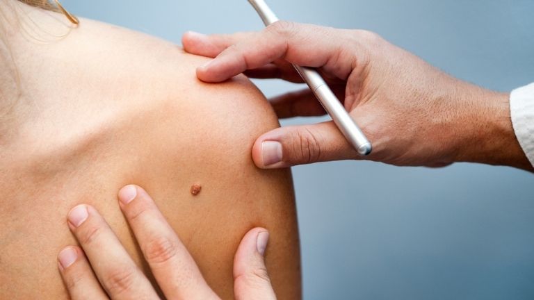 Warning signs of cancerous moles and what to do about them MAIN