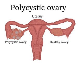 A-gynaecologists-guide-to-Polycystic-Ovary-Syndrome.jpg