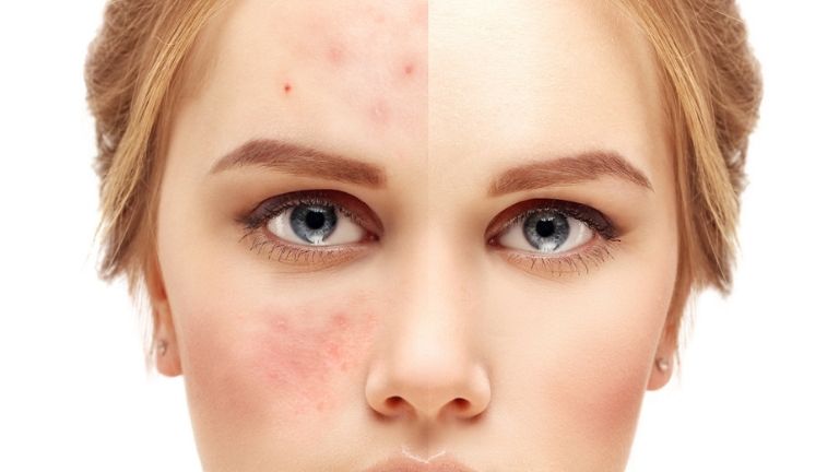 Here's what your spots are trying to tell you about your health MAIN