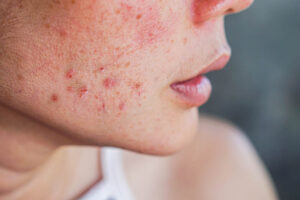 Heres-what-your-spots-are-trying-to-tell-you-about-your-health-woman-with-cheek-acne.jpg