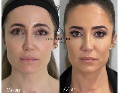 E4’s Body Fixer Dr Nina Bal reveals results of her amazing non-surgical face lift FEATURED