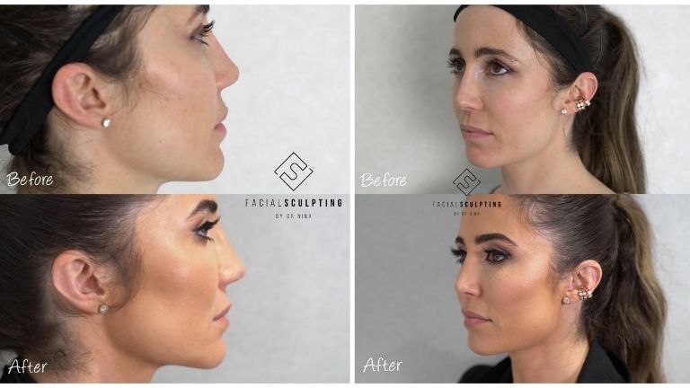 E4’s Body Fixer Dr Nina Bal reveals results of her amazing non-surgical face lift MAIN