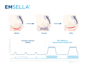 emsella pelvic floor images 2