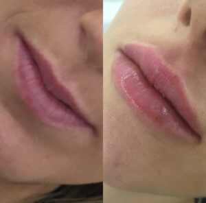 natali kelly lips