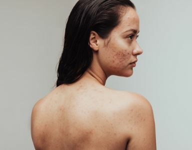 adult acne FEATURED