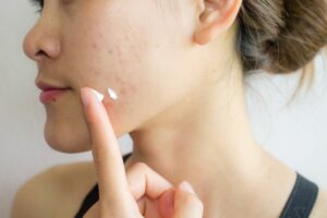 woman applying spf to skin to prevent adult acne formation