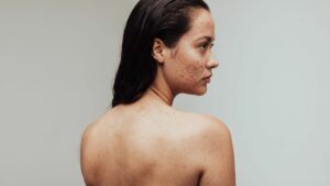 woman with adult acne