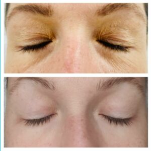 Dr-Preema-London-Light-Eyes-dark-circles-under-eyes-before-and-after.jpg