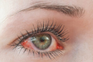 hayfever-symptoms-red-itchy-eyes.jpg