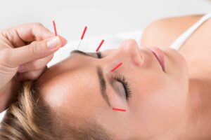 Menopause symptoms? 4 proven reasons acupuncture could be the holistic alternative to HRT