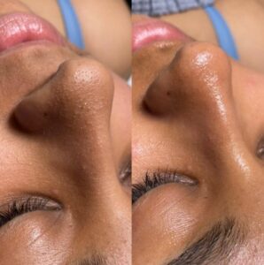 Before and After Hydrafacial