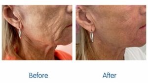 Saggy skin This non surgical facelift can take years off your face MAIN