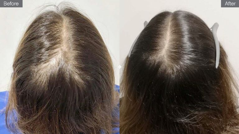 Thinning hair? Receding hairline? This micro needling scalp treatment  promotes hair growth