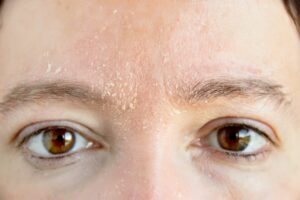 dry flaky skin iodine deficiency