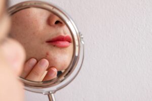 skin barrier woman looking at skin in mirror