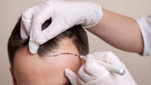 hair loss hair transplant trichologist